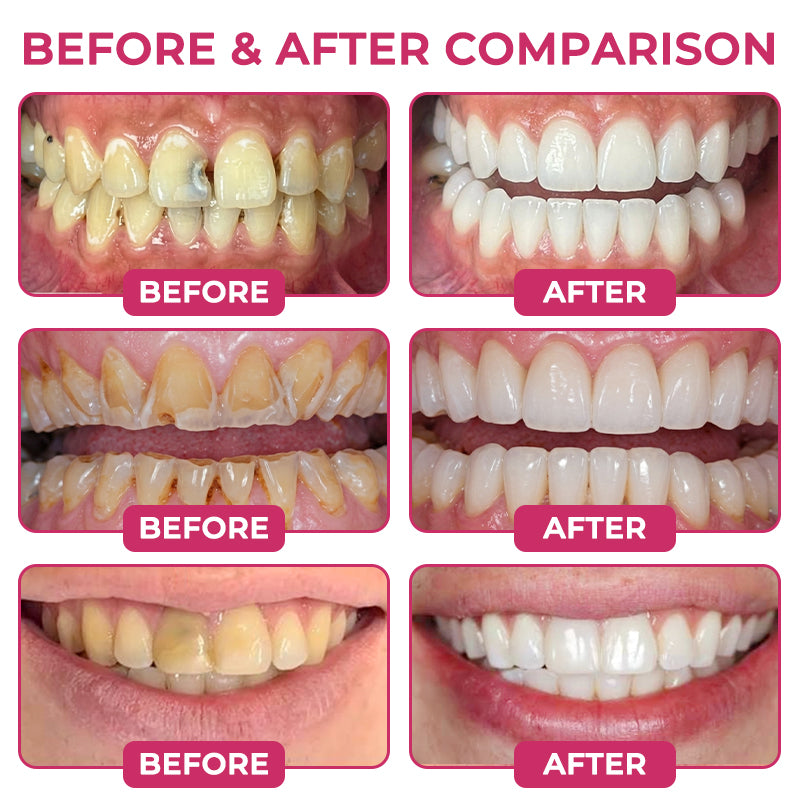 Natravor® DenPerm Cavity-Repair Natural Enamel Filling Gel