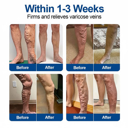 🇺🇸👨‍⚕️✅Natravor®  VeinEase Microneedle Care Patch⚡Instant Relief, Long-Term Results